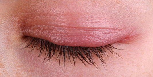 What is blepharitis?