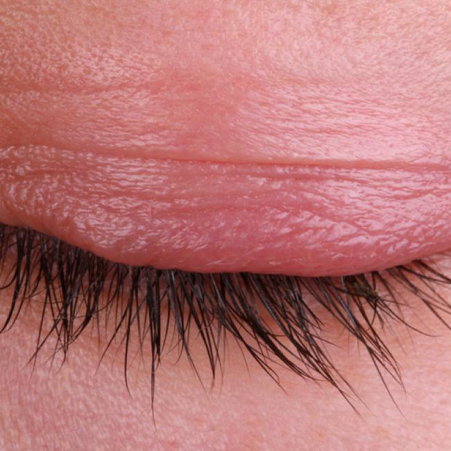 What is blepharitis?